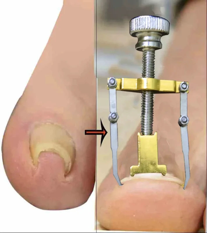 নখের কোনা সোজা করার অত্যাধুনিক যন্ত্র ( Nail Repair | MNK SHOP